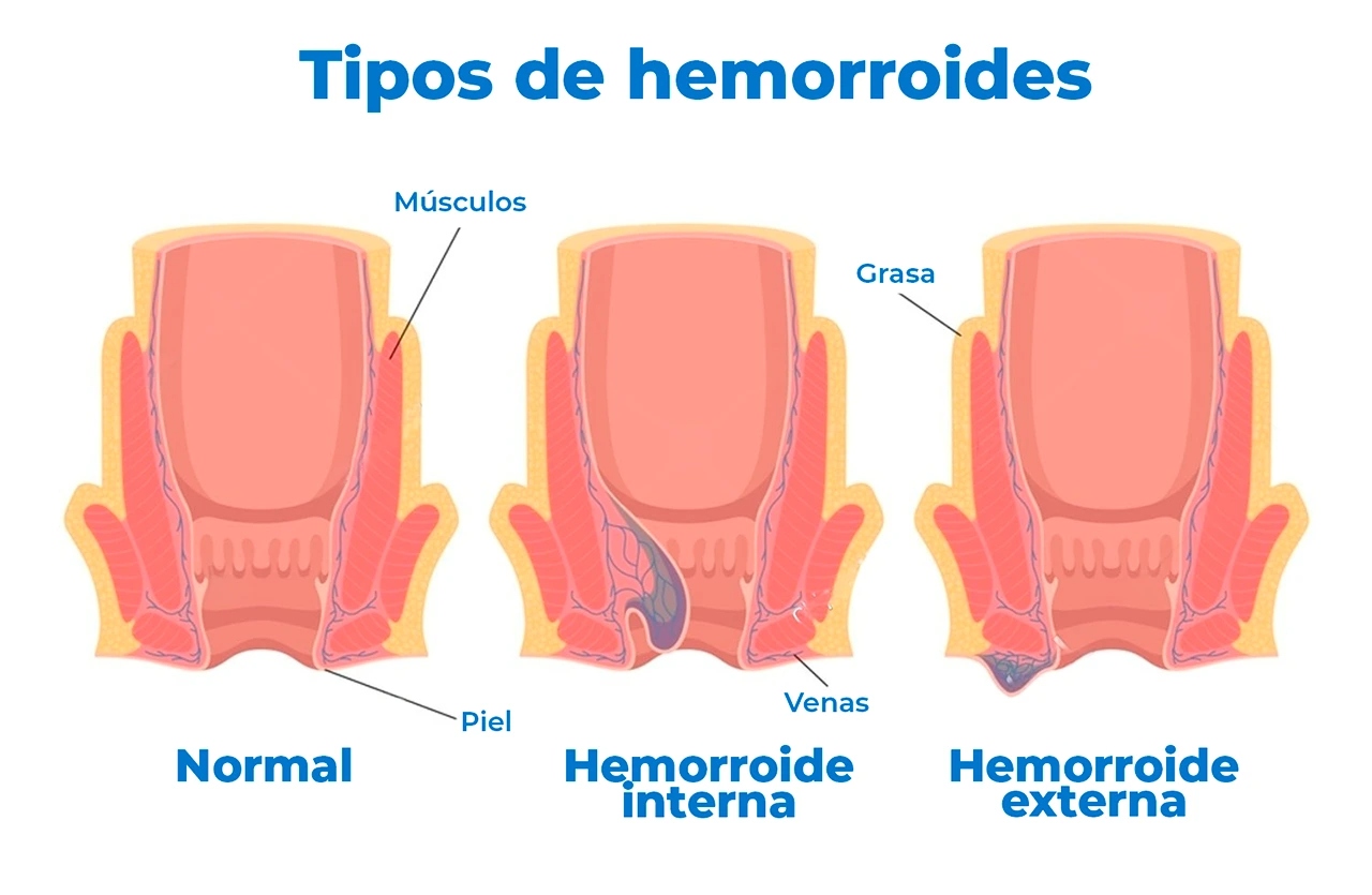 tratamiento de las hemorroides